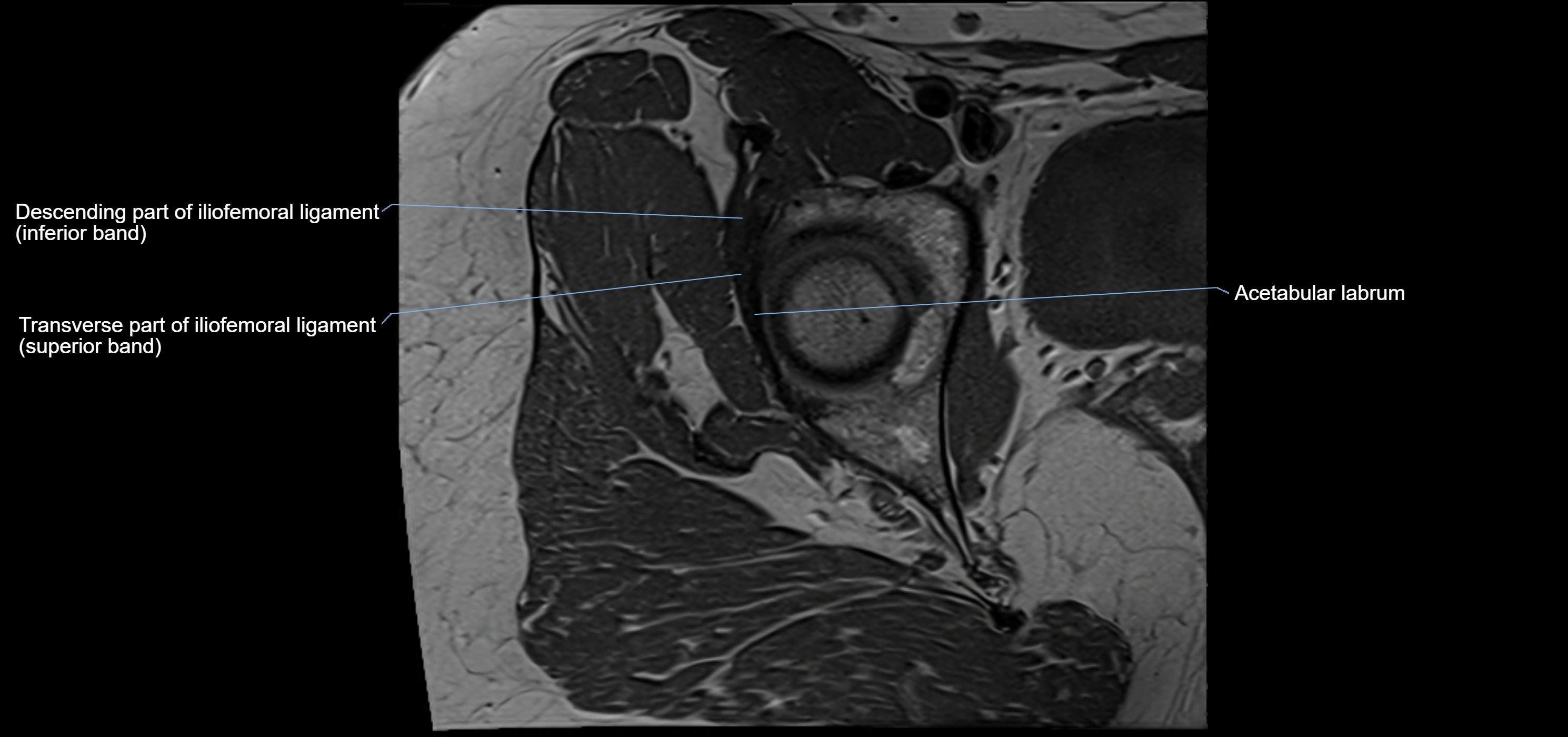 Hip ligament anatomy axial 3T MRI image -img-13001-00011.webp
